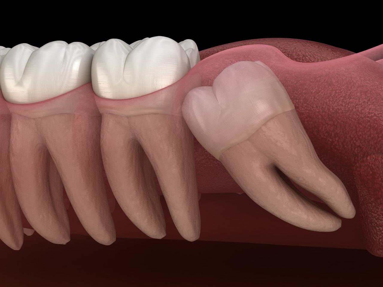 Ретенция зубов
