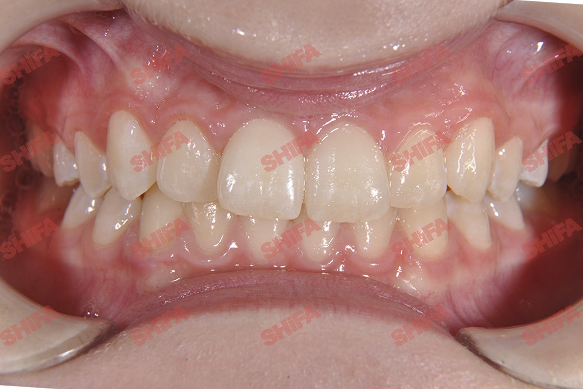 Ортодонтическое лечение в период сменного прикуса - результат после 1