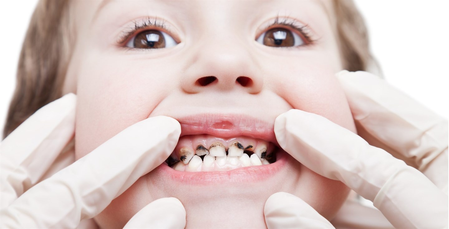 Почему возникают боли у сладкого зуба: основные причины и способы лечения