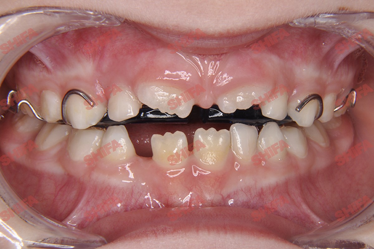 Ортодонтическое лечение в период сменного прикуса - результат до 1