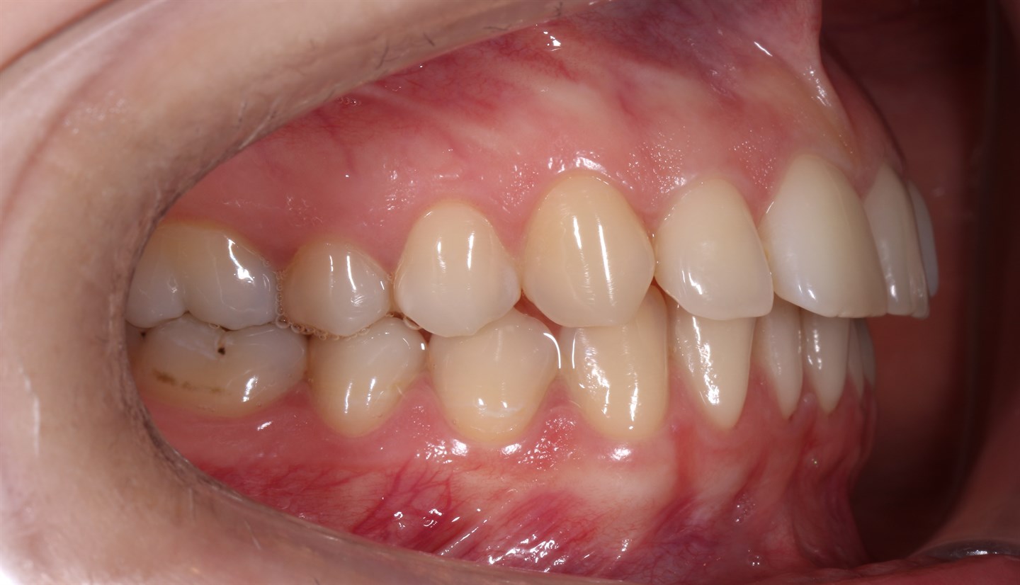 Перфорация гайморовой пазухи при удалении зуба