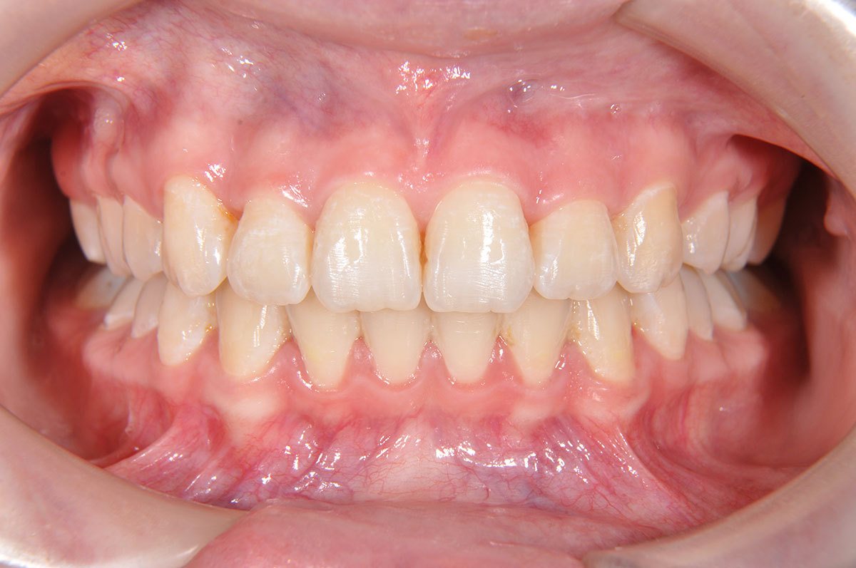 Лечение на брекетах с удалением зубов - результат после 3