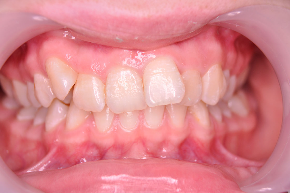 Лечение на брекетах с удалением зубов - результат до 1