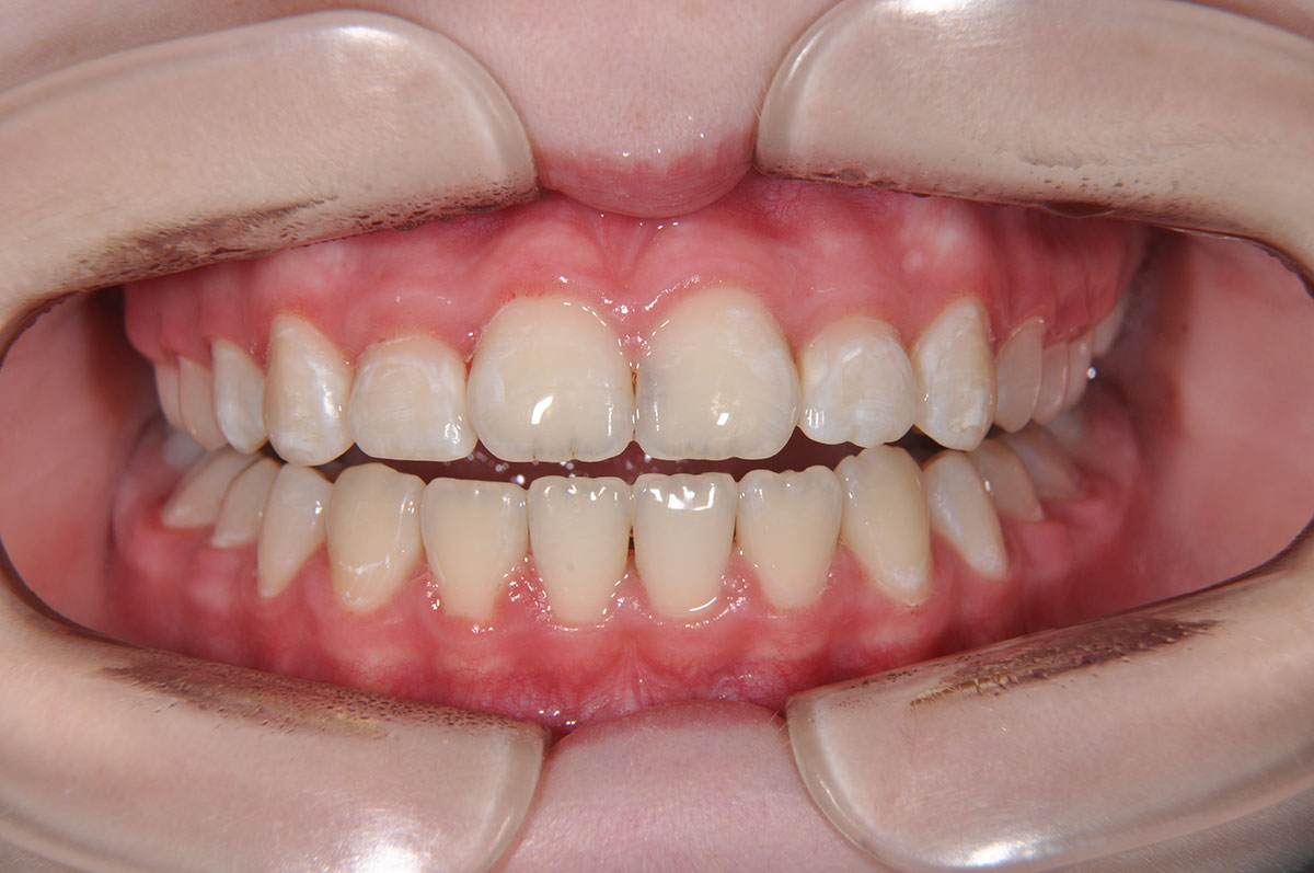Ортодонтическое лечение с использованием пластин и металлических брекет систем - 11