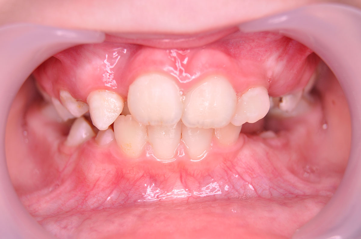 Ортодонтическое лечение с использованием пластин и металлических брекет систем - 1