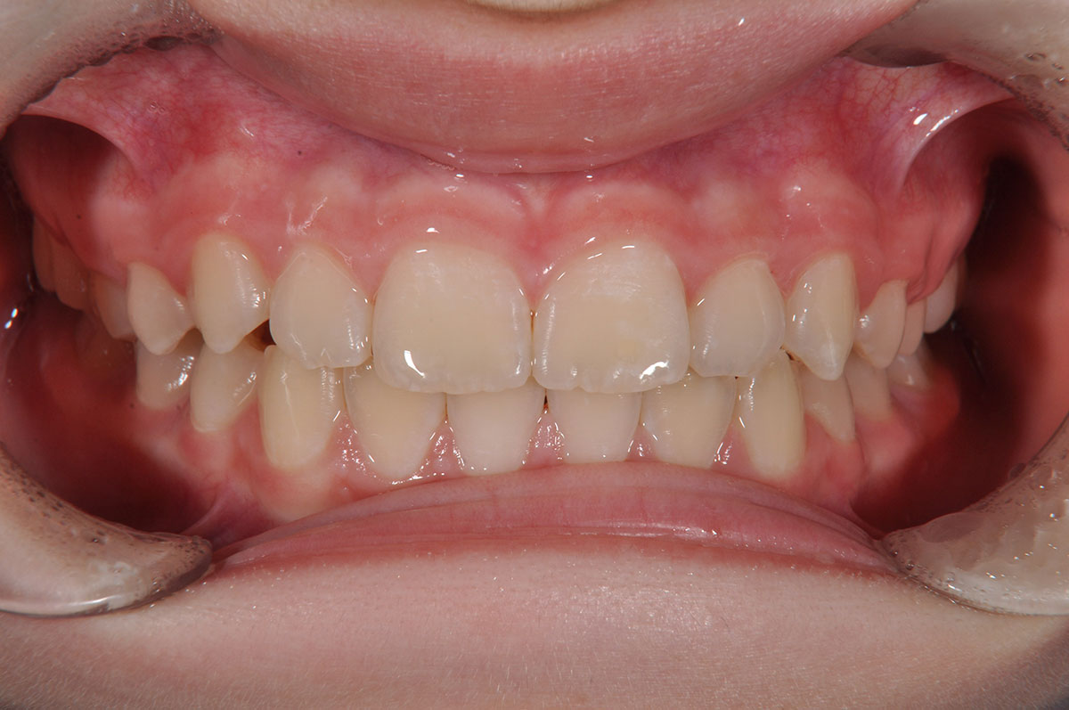 Формирование прикуса с использованием пластинки для зубов - результат лечения 4