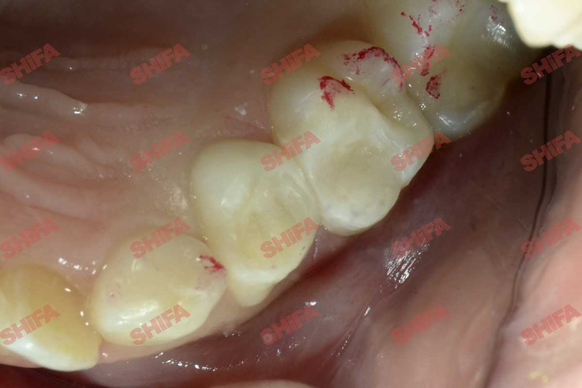 Лечение кариеса молочных зубов после -2