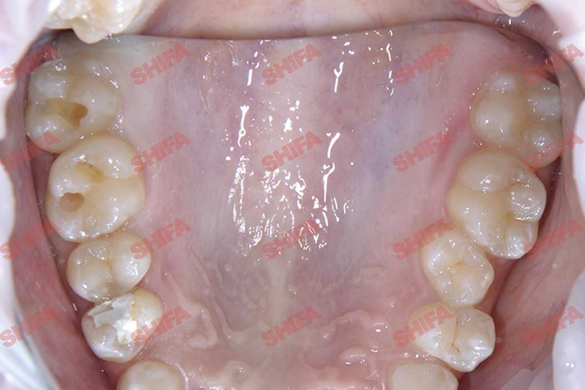 Лечение кариеса молочных зубов до -1
