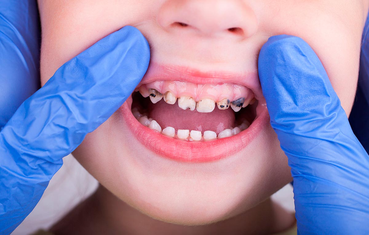 Почему чернеют зубы у детей