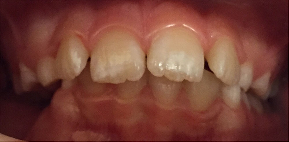 Дисплазия зубов у детей