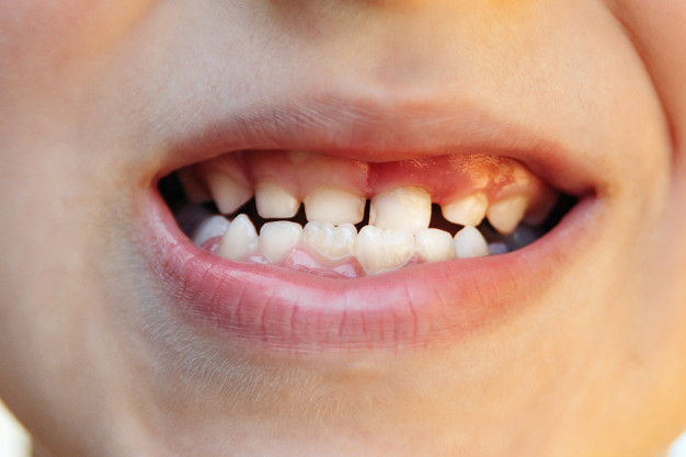 Флюороз эмали зубов у детей