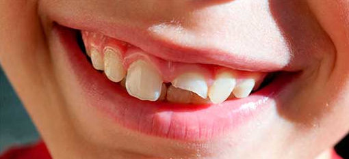 Что делать после ушиба зуба и как распознать травму зуба