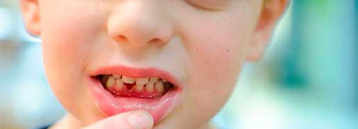 Травмы молочных зубов у детей